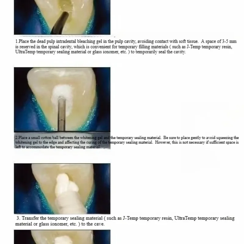 Matériaux de restauration dent - Teeth Whitening Effects avis et prix