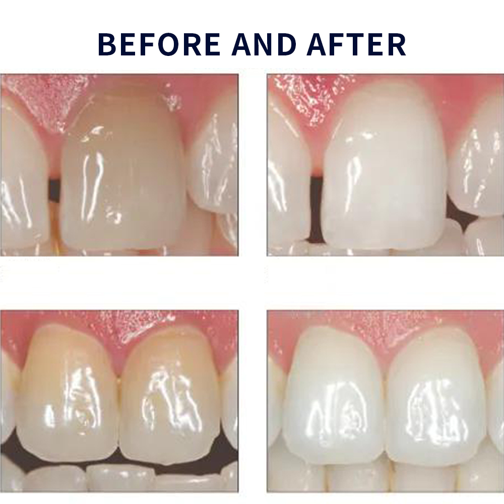 Opalwisdom-Kit de Blanchiment  - Teeth Whitening Singapore avis et prix