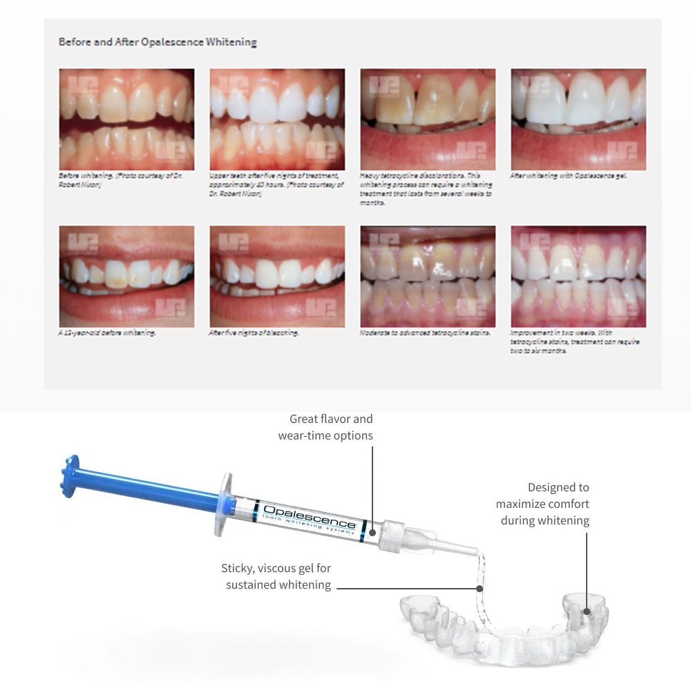 Opalwisdom-Kit de Blanchiment  - Teeth Whitening Singapore avis et prix