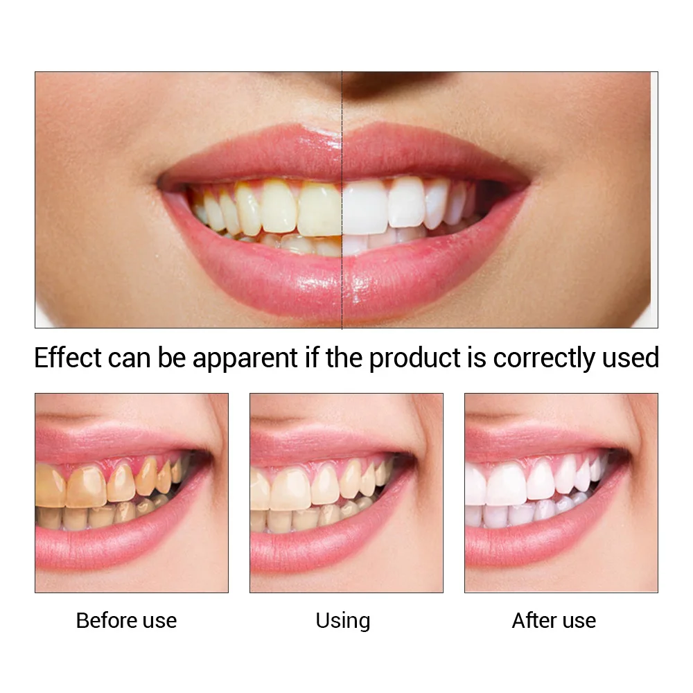 FTEENPLY poudre d'essence de b - Teeth Whitening Singapore avis et prix