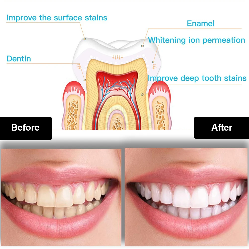 Kit de blanchiment des dents d - Teeth Whitening Singapore avis et prix